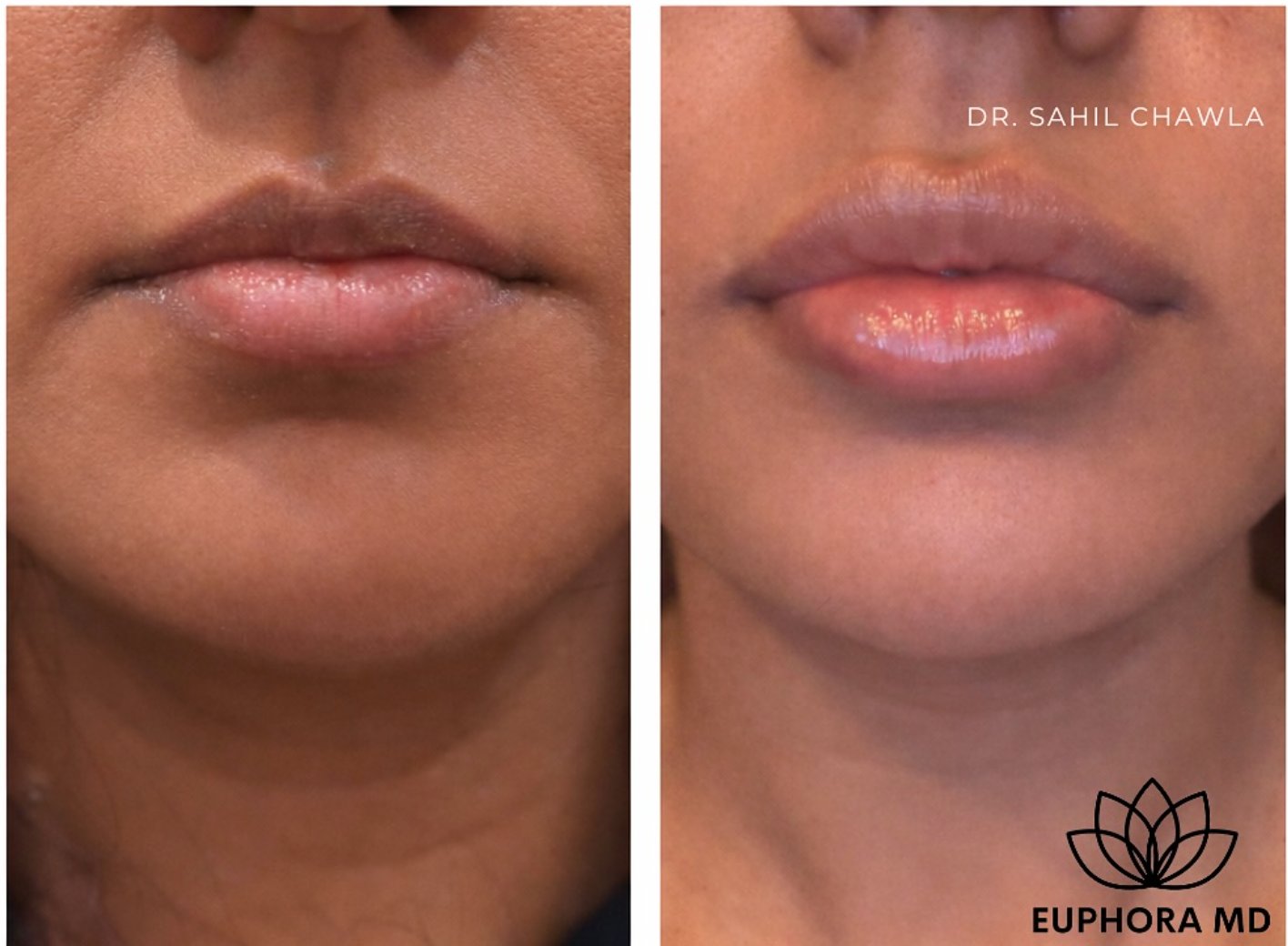 Before & After — Lip Filler